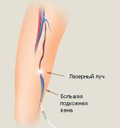 подкожная вена на ноге