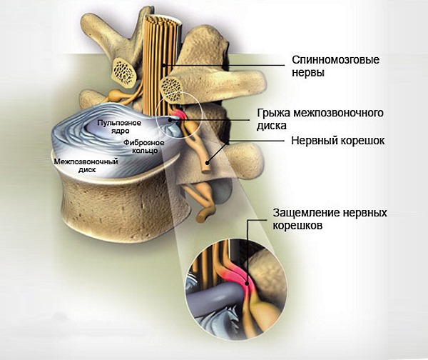 Разрыв межпозвоночного диска, который сдавливает корешки
