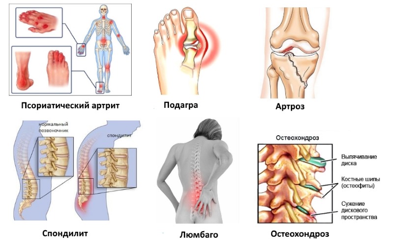 Противовоспалительное средство назначают при ревматических и воспалительных заболеваниях суставов