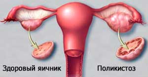 поликистоз яичников