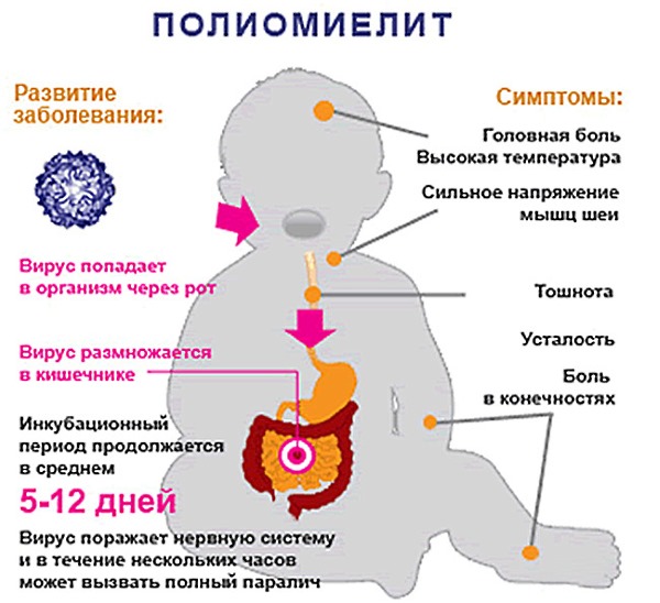 Симптоматика при поражении полиомиелитом похожа на общие признаки любой вирусной болезни