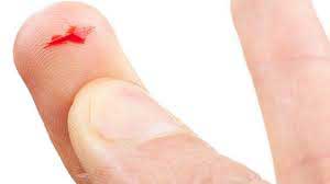 порез пальца
