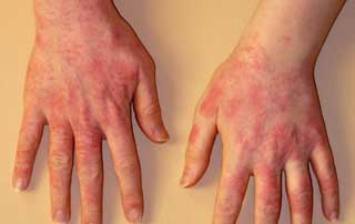 покраснение рук