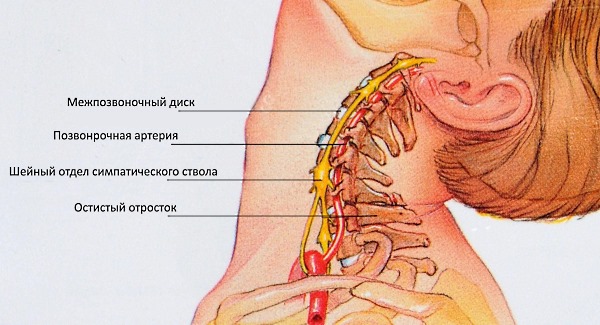 Грыжа шейного отдела опасна тем, что пережимается позвоночная артерия