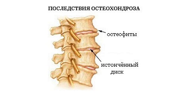Чаще всего причиной дорсопатии является остеохондроз