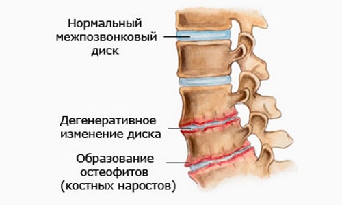 Большинство дегенеративных изменений в позвонках шеи сопровождаются хрустом