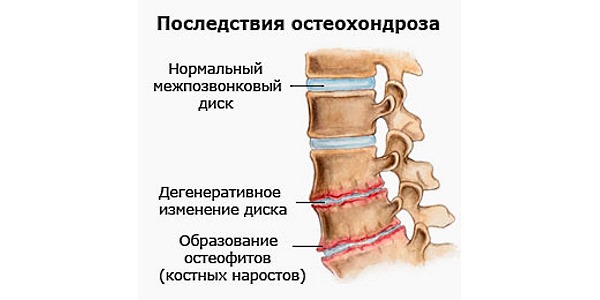 Остеохондроз характеризуется стиранием межпозвоночных дисков