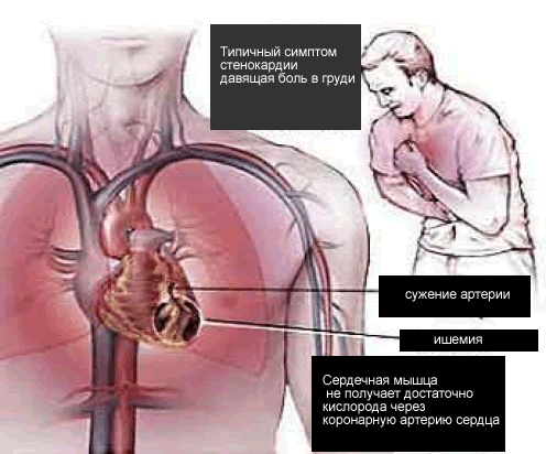 последствия стенокордии