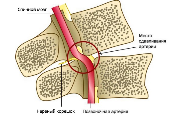 При нестабильности позвонков может произойти защемление артерии и нервных корешков