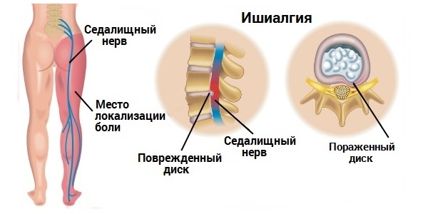 Баралгин М способен устранить неврологическую боль