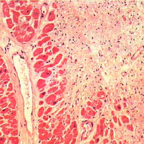 постинфарктный вид