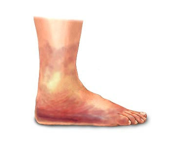 отёчная форма