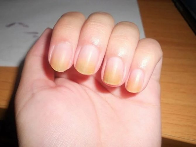 Потемнения на ногтях после наращивания и гель-лака – это не грязь, а инфекция