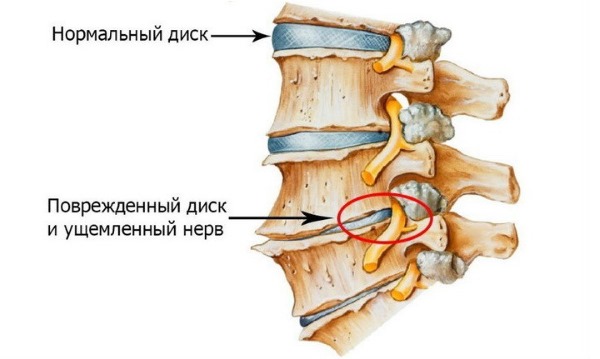 Радикулит - это сдавливание корешка нерва, вызванного другими заболеваниями позвоночника