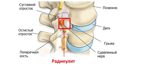 Радикулит не болезнь, а симптом отклонений в позвоночнике