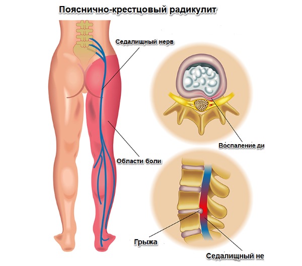 Радикулопатия развивается в следствии защемления нервного корешка в поясничном отделе позвоночника