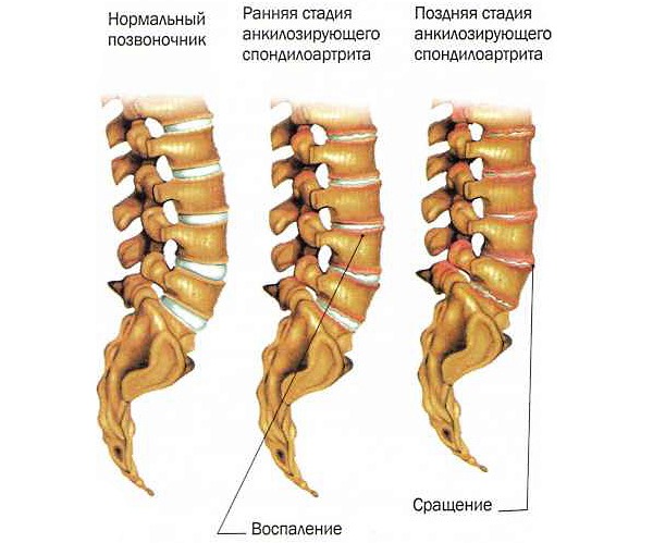 Противовоспалительный препарат назначают при воспалении суставов