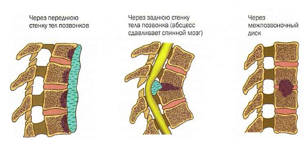 Возможные места поражения позвоночника инфекцией
