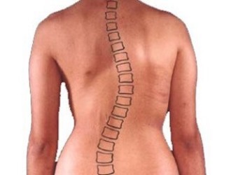 Правосторонний сколиоз развивается в результате нарушения осанки