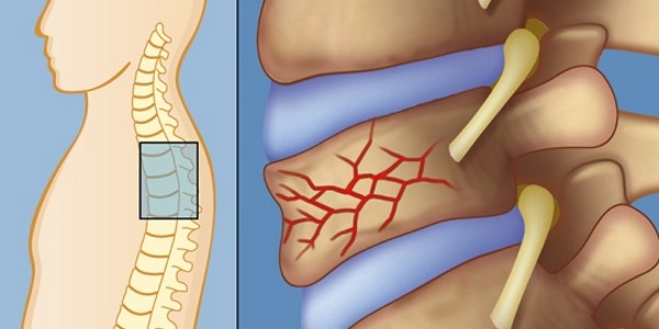 Чаще всего при ушибах спины страдает позвоночник