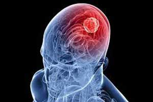 отек головного мозга