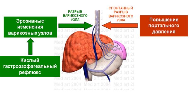 кровотечение пищевода