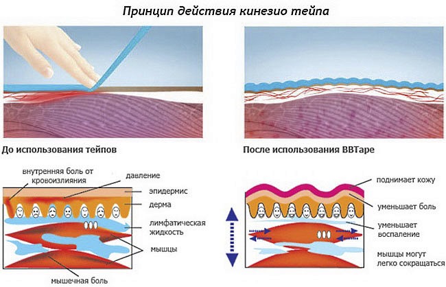 Механизм действия тейпов