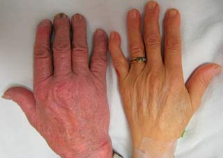 припухлость суставов