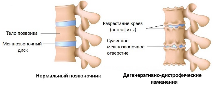 Артифлекс рекомендуется принимать тем, кто страдает дегенеративными патологиями опорно-двигательного аппарата