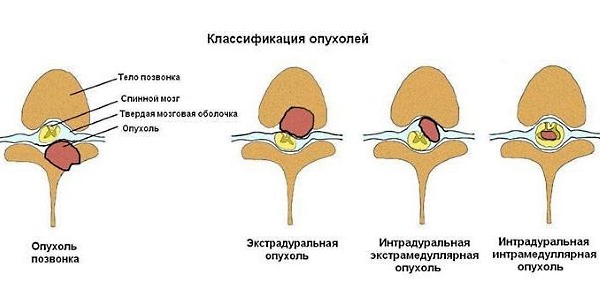 Обратите внимание на типы поражения позвоночника раком