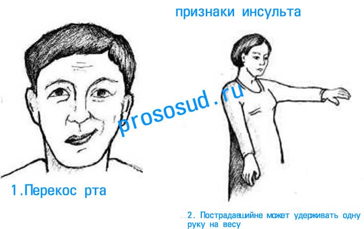 признаки инсульта