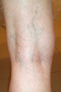 вены на ногах