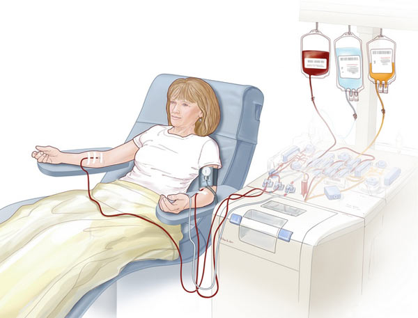 процедура плазмафереза