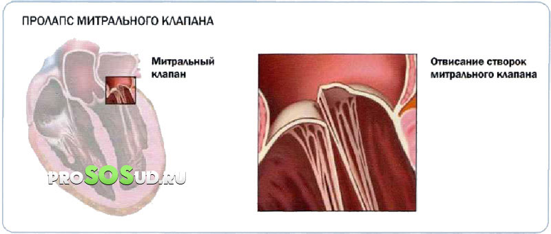 пролапс митрального клапана