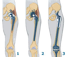 протез в ноге