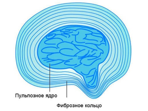 При отсутствии лечения дегенеративных изменений диска фиброзное кольцо может разорваться и образуется позвоночная грыжа