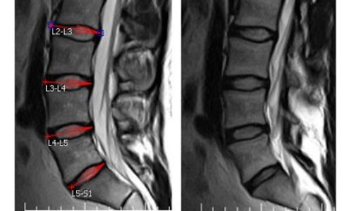 Наиболее эффективный метод диагностики протрузии диска - МРТ