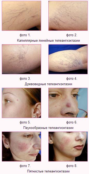 проявления телеангиэктазии