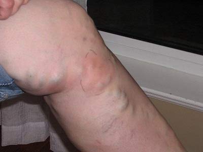 проявления тромбофлебита