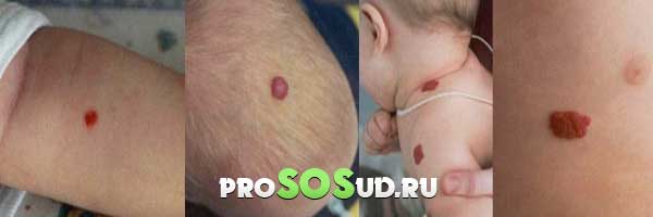 проявление гемангиом