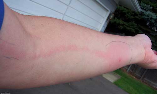 Проявление лимфангита