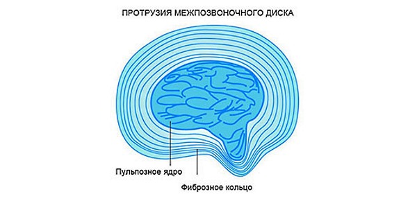 При грыже позвоночника происходит разрыв фиброзного кольца и вытекание пульпозного ядра
