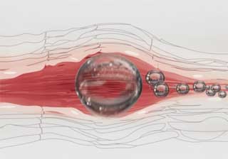 пузырек воздуха в сосудах