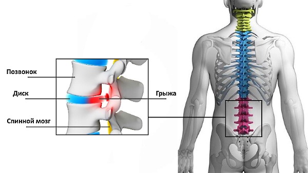 Чаще всего межпозвоночная грыжа диагностируется в поясничном отделе