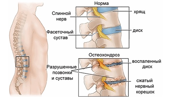 Миорикс помогает устранить мышечный спазм при лечении остеохондроза