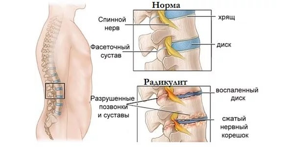 Достаточно эффективно применение Пиралгина при радикулите