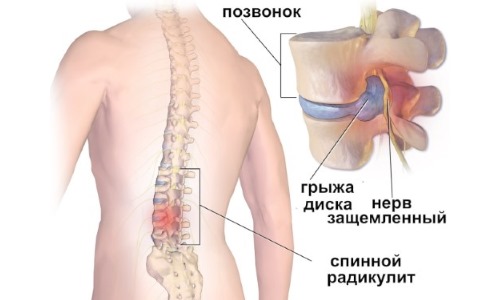 Наятокс позволяет устранить боль невралгического характера