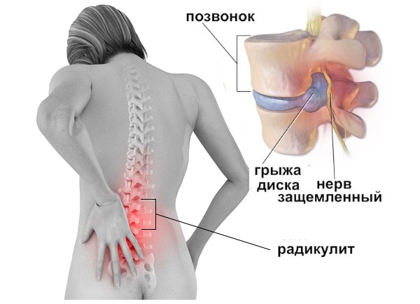 Пенталгин H способен устранить боль при радикулите и других типах невралгии