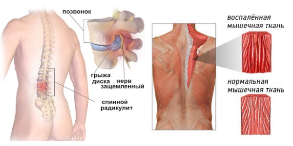 Используют настойку из стручкового перца при суставных, невралогических и мышечных болях