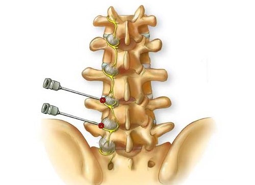 Деструкция фасеточных суставов - устранение болевых рецепторов